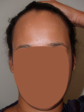hairline advancement - patient 40 - before 1
