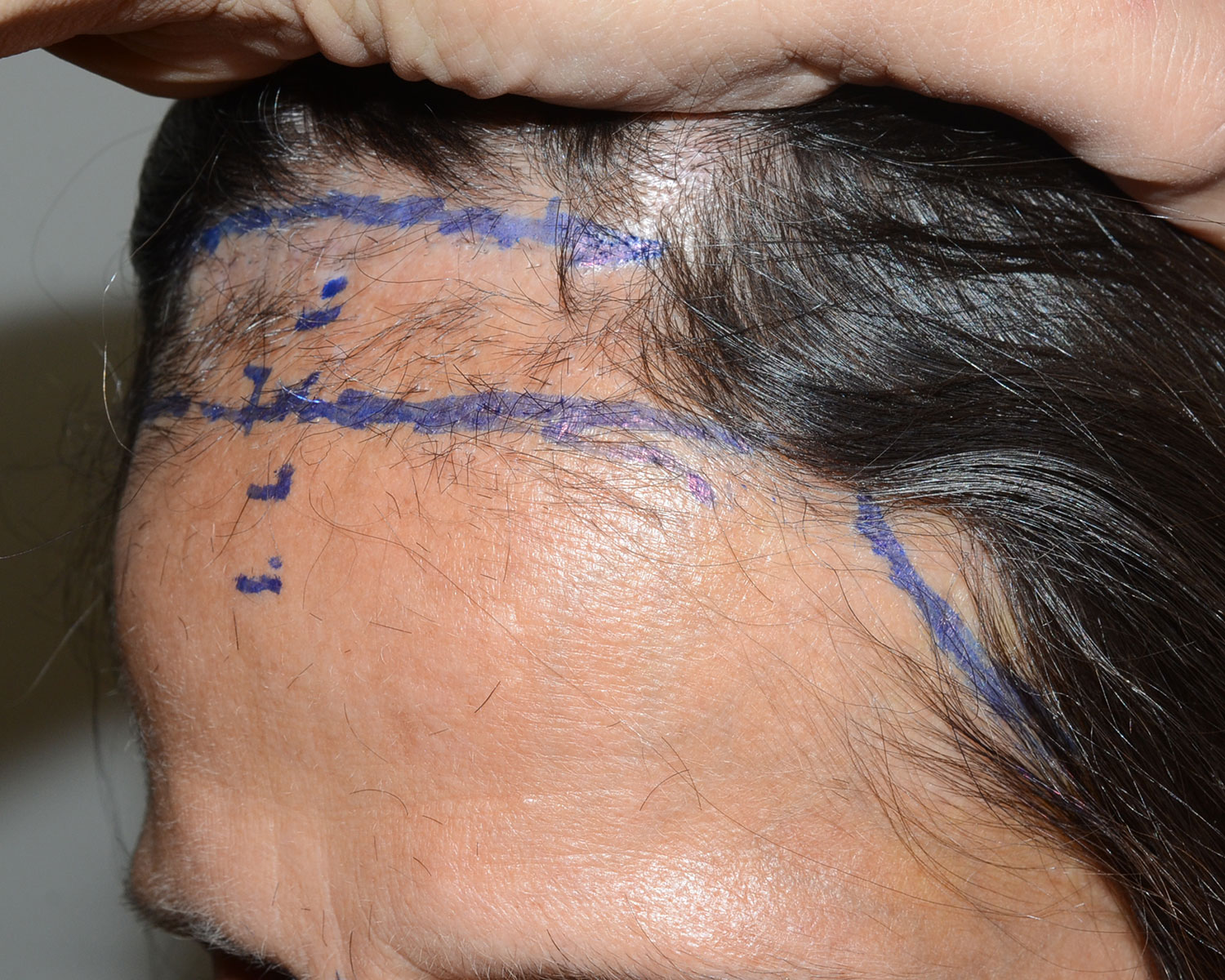 Frontal Fibrosing Alopecia Dr Epstein